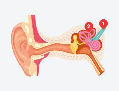 Pérdida autiditiva neurosensorial